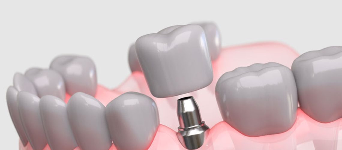 Highly detailed 3D illustration showing a dental implant in place within the jawbone and gum tissue.
